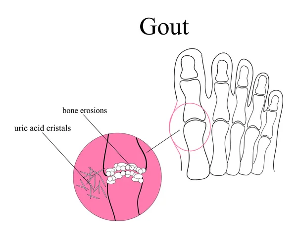 Diagram of gout in human toe illustration — Stock Vector