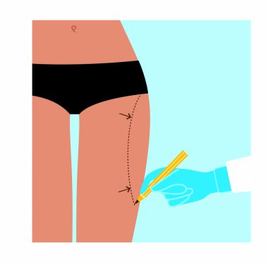Kadının kalçasında estetik ameliyat. Vektör illüstrasyonu.