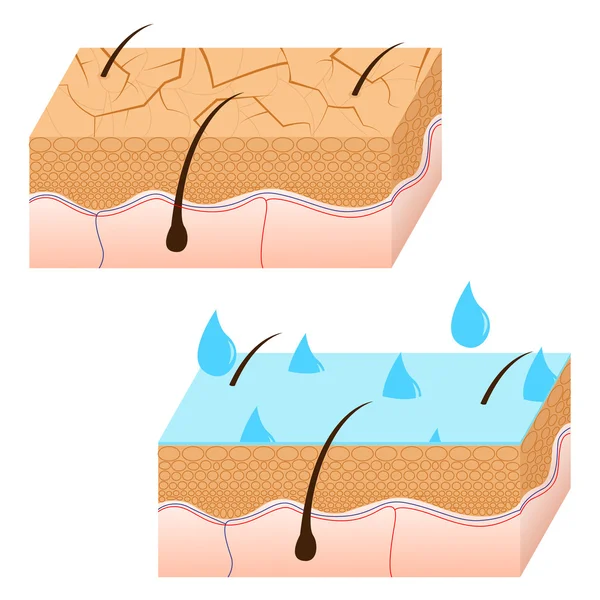 Hydratation de la peau et peau sèche vue de section . — Image vectorielle