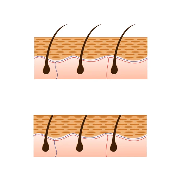 Depilazione e pelle con vista sezionale dei capelli . — Vettoriale Stock