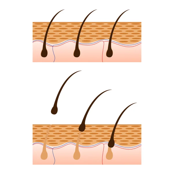 Епіляція та шкіра з роздільним видом на волосся . — стоковий вектор