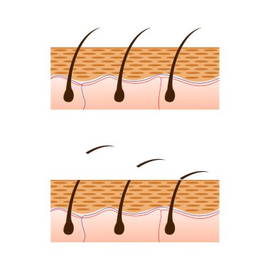 Epilasyon ve cilt saç kesit görünümü ile.