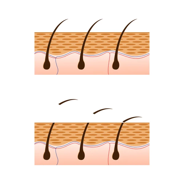 Depilazione e pelle con vista sezionale dei capelli . — Vettoriale Stock