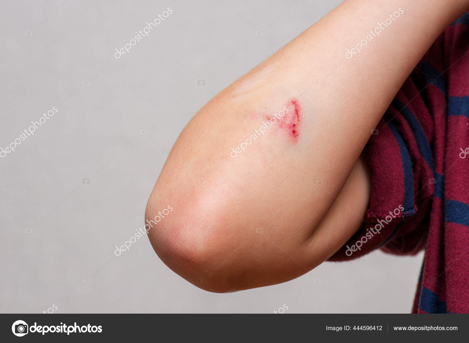 Deep Scratches Skin Bruises Childs Hand Wounds Scratches Abrasions ...