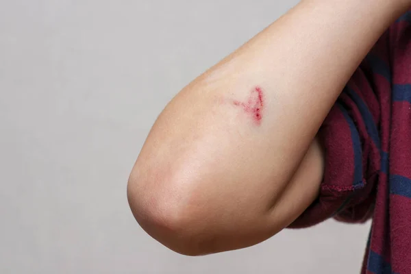 Riscos Profundos Pele Com Hematomas Mão Das Crianças Feridas Arranhões — Fotografia de Stock