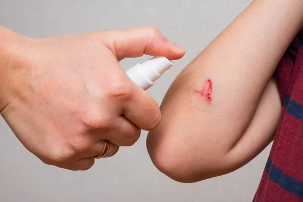 Womans hand sprays an antiseptic agent on the wound on the childs hand. Treatment the wound. First Aid.