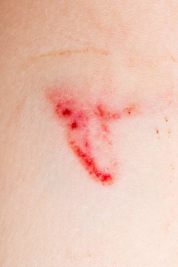 İnsan vücudunda derin bir yara, yakın mesafeden yara izi. Deride derin çizikler ve çürükler var..