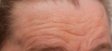 Yaşlı kadın alnını buruşturmuş. Yaşlı kadın, yakın plan portresi. Kırışıklıklar. Yüz derisi sorunları. Yüzünde lekeler ve kırışıklıklar var. Yaşlı bir kadının yüzünde sarkık ve buruşuk bir ten.