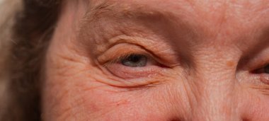 Buruşuk suratlı yaşlı kadın. Yaşlı kadın, yakın plan portresi. Kırışıklıklar. Yüz derisi sorunları. Yüzünde lekeler ve kırışıklıklar var. Yaşlı kadın yüzünde sarkık ve buruşuk bir ten. Gülen surat.