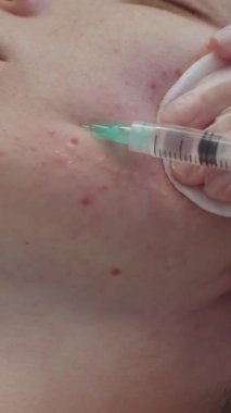 Bir dermatologla seans. Terapist derinin altına bir solüsyon enjekte ediyor. Orta çekim