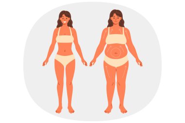 Ameliyattan önce ve sonra kilolu kadın iç çamaşırlarıyla poz verdiği için yağ aldırma. Liposuction 'a ihtiyacı olan güzel bir kız diyet ve fitness kullanmadan elde edilen ilerlemeyi gösteriyor.