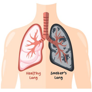 Sağlıklı Akciğer, Sigara İçmenin Etkisi 'ne Karşı