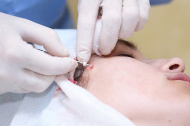 Yüz cerrahisi kaldırma prosedürü.