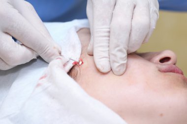 Yüz cerrahisi kaldırma prosedürü.