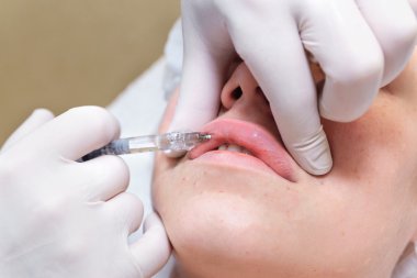 Dolgu ile dudak enjeksiyon prosedürü.