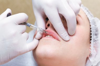 Dolgu ile dudak enjeksiyon prosedürü.