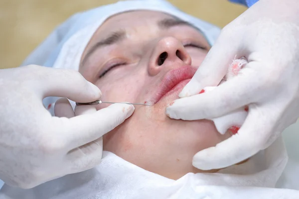 Procedimiento de cirugía de lifting facial . — Foto de Stock