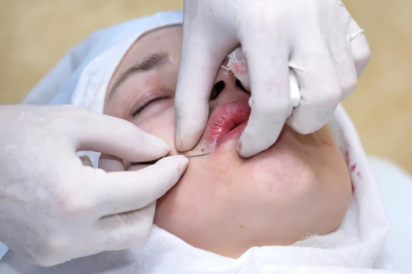 Procedimiento de cirugía de lifting facial . — Foto de Stock