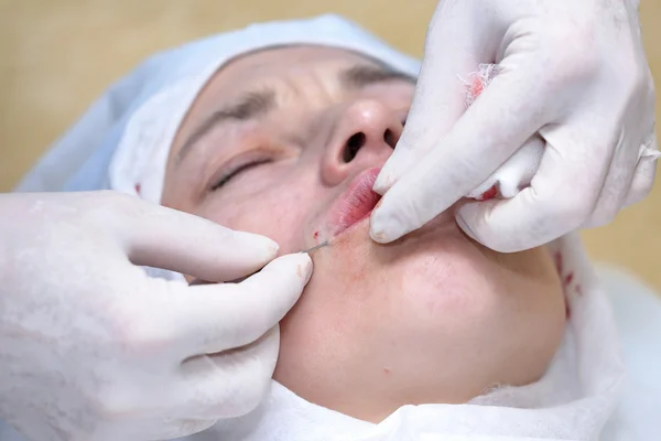 Procedimiento de cirugía de lifting facial . — Foto de Stock