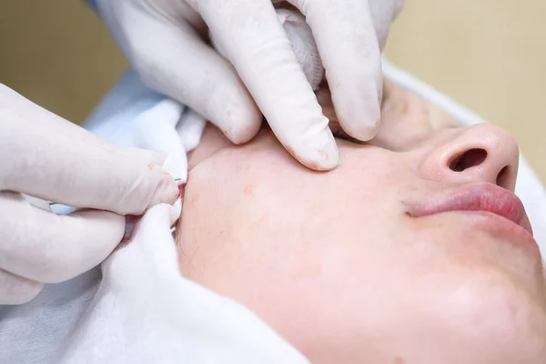 Procedimiento de cirugía de lifting facial . — Foto de Stock