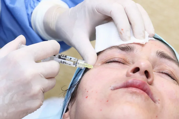 Biorevitalización con tratamiento con ácido hialurónico de guiño mímico — Foto de Stock