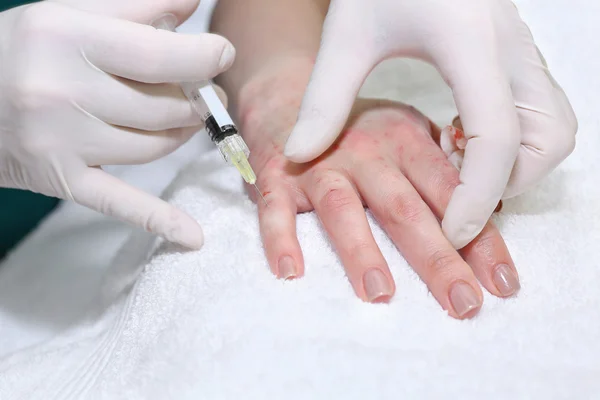 Anti-Age-Injektionstherapie. Handverjüngung. — Stockfoto