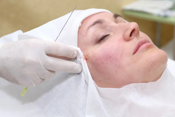 Procedimiento de cirugía de lifting facial . — Foto de Stock