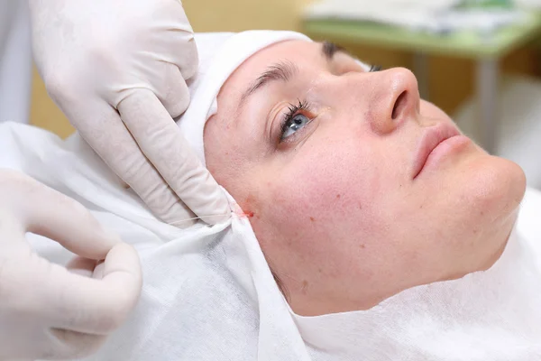 Procedimiento de cirugía de lifting facial . — Foto de Stock