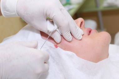 Yüz cerrahisi kaldırma prosedürü.