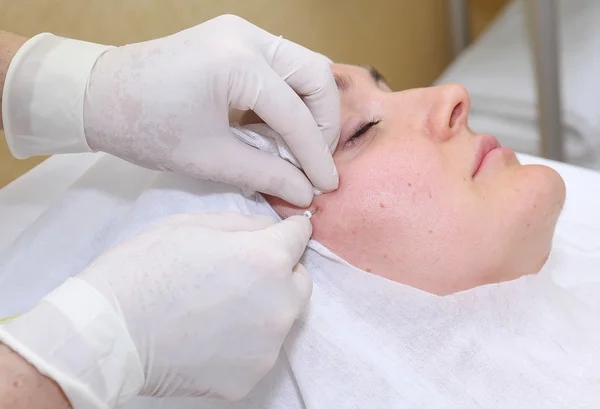 Procedimiento de cirugía de lifting facial . — Foto de Stock