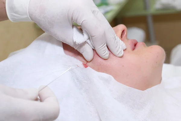 Procedimiento de cirugía de lifting facial . — Foto de Stock