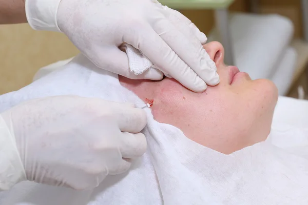 Procedimento de cirurgia de elevação facial . — Fotografia de Stock