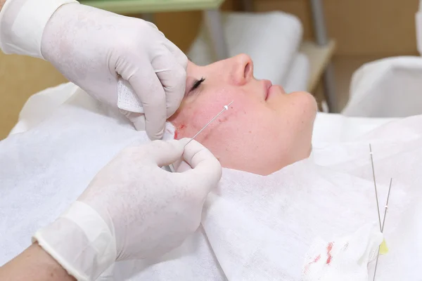 Procedimiento de cirugía de lifting facial . — Foto de Stock