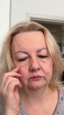 woman with natural eyebrows and eyelashes applying eye cream to her puffy eyelids. Concepts of facial plastic surgery, eyelid lift, blepharoplasty, cosmetology, surgically remove bags under the eyes
