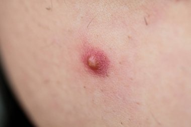 Deride sivilce. Yakın plan.