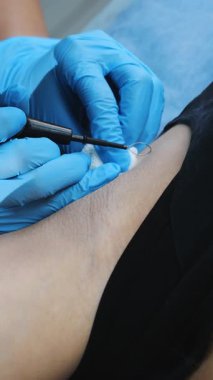 Profesyonel estetik klinik ortamında cilt lezyonunun kapatılması için ilmekli alet ve eldiven kullanılıyor..