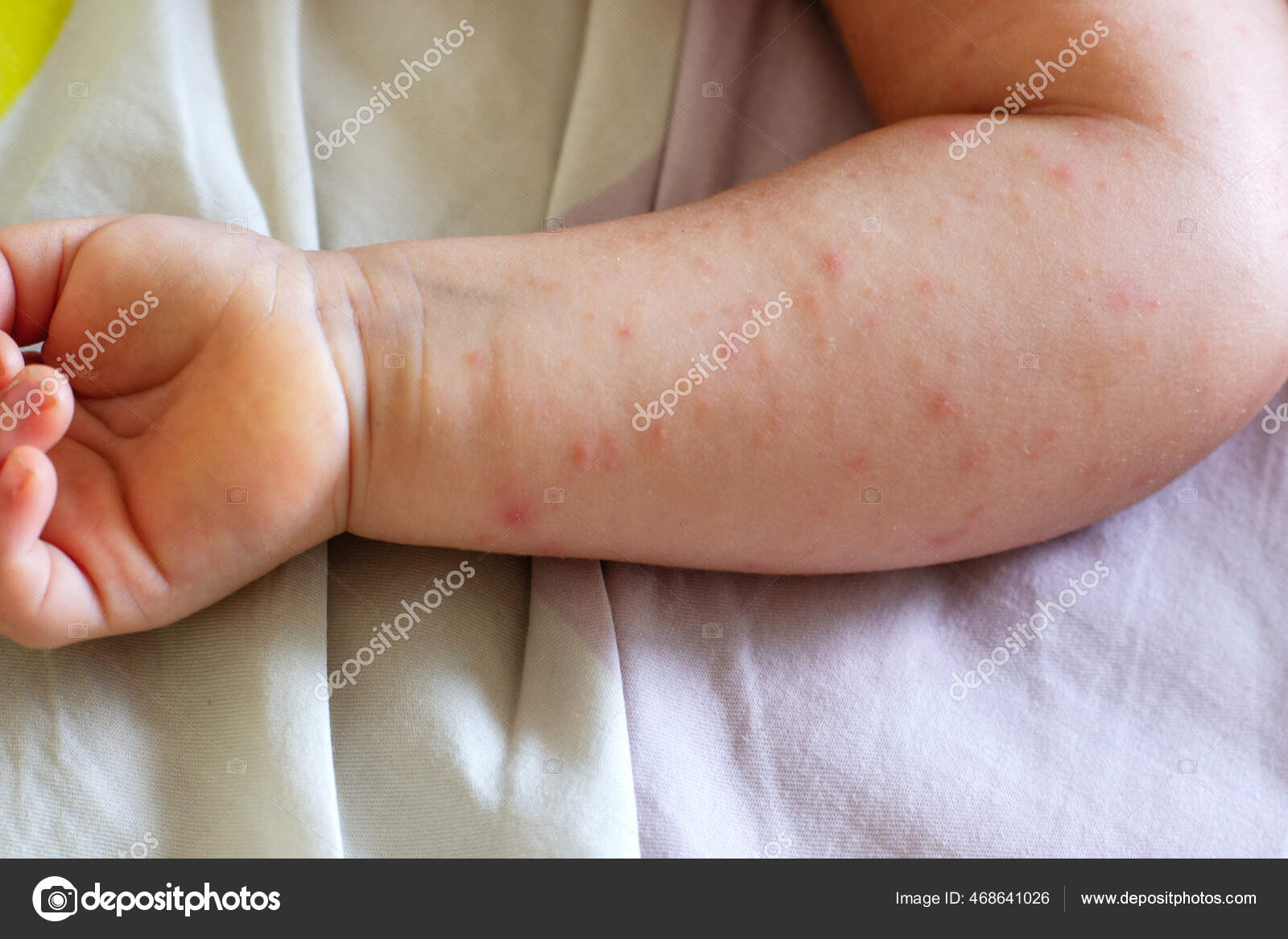Manifestação Dermatite Atópica Mão Uma Criança Pequena Braço Bebê Close —  Foto © Zenobillis #468641026, image size:1600x1167