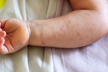 Küçük bir çocuğun elinde atopik dermatit belirtileri. Bebek kolu yakın plan.