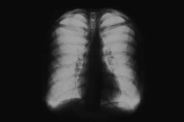 Ray Film Human Chest Radiograph Lungs People Black White Image — Stock Photo, Image