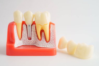 Diş implantı, çeneye yapay diş kökleri.