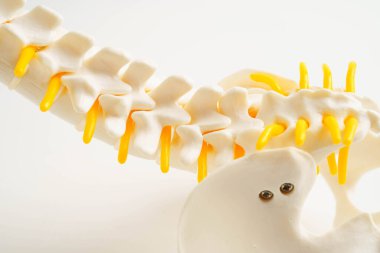 Omurga ve kemik, bel kemiği yerinden oynamış disk parçası, ortopedi bölümünde tedavi için model..