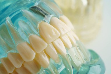 Diş implantı, çeneye yapay diş kökleri, diş tedavisinin kök kanalı, diş eti hastalığı, diş hekimliği üzerine çalışan dişçi modeli.