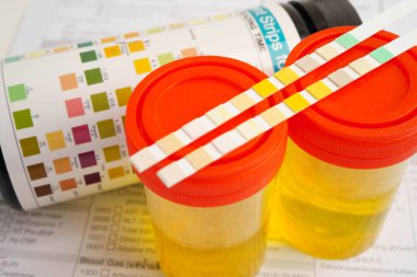 İdrar tahlili, reaksiyonlu idrar kabı. PH kağıt testi ve karşılaştırma tablosu laboratuvarda..