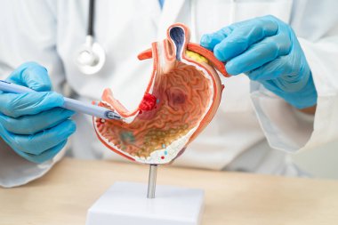 Mide hastalığı, hastanede teşhis ve tedavi için anatomi modeli tutan bir doktor..