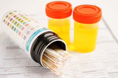 İdrar tahlili, reaksiyonlu idrar kabı. PH kağıt testi ve karşılaştırma tablosu laboratuvarda..