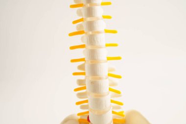 Omurga ve kemik, bel kemiği yerinden oynamış disk parçası, ortopedi bölümünde tedavi için model..