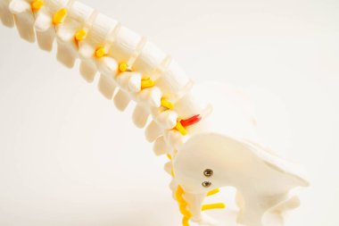 Omurga ve kemik, bel kemiği yerinden oynamış disk parçası, ortopedi bölümünde tedavi için model..