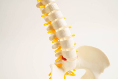 Omurga ve kemik, bel kemiği yerinden oynamış disk parçası, ortopedi bölümünde tedavi için model..