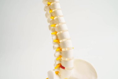 Omurga ve kemik, bel kemiği yerinden oynamış disk parçası, ortopedi bölümünde tedavi için model..