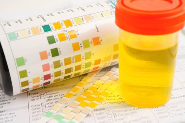 İdrar tahlili, reaksiyonlu idrar kabı. PH kağıt testi ve karşılaştırma tablosu laboratuvarda..